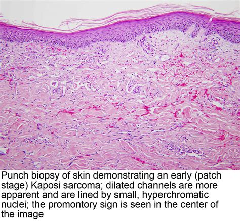 Pathology Outlines - Kaposi sarcoma