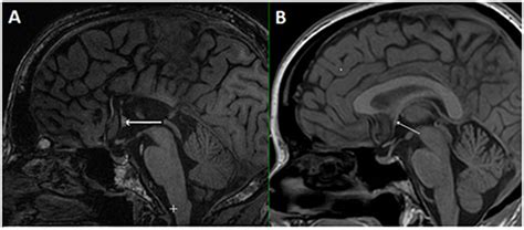 Anterior Commissure Mri