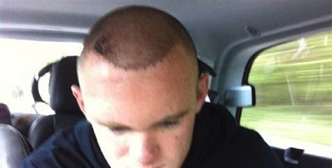 WAYNE ROONEY HAIR TRANSPLANT PHOTO