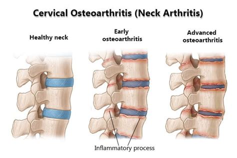 Cervical Osteoarthritis (Neck Arthritis) Treatment in NYC | New York ...