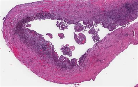 Residual Cyst Histology | Porn Sex Picture