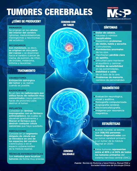 Tumores cerebrales - Infografía