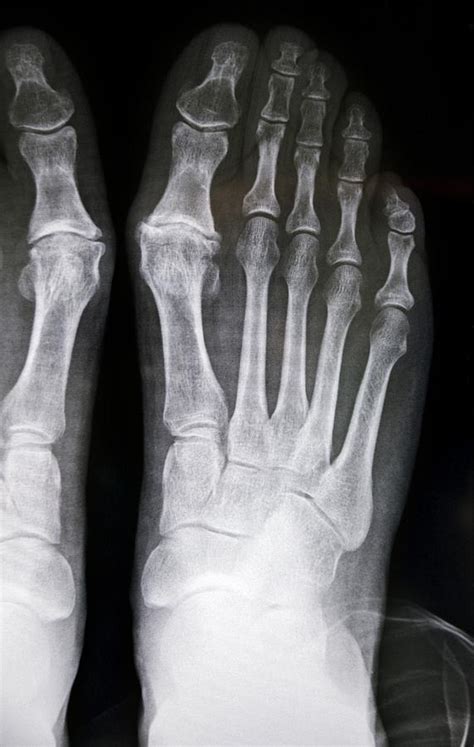 Hallux rigidus before surgery, X-ray by Science Photo Library