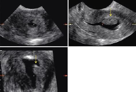 Endometrial Polyps | Radiology Key