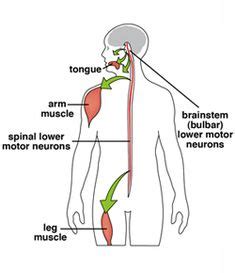 August 10, 2013: Spinal and bulbar muscular atrophy (SBMA), also known ...