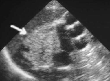 Prune Belly Syndrome Imaging: Overview, Radiography, Computed Tomography