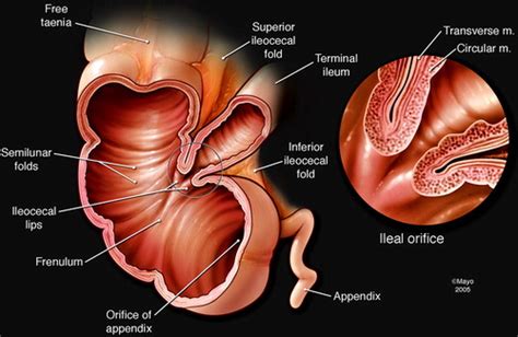 Spectrum of Normal and Abnormal CT Appearances of the Ileocecal Valve and Cecum with Endoscopic ...