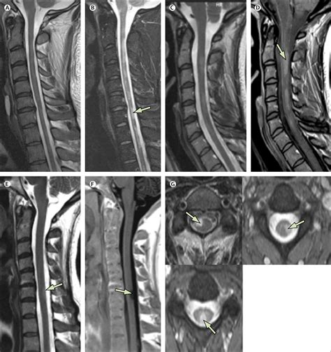 Spinal cord involvement in multiple sclerosis and neuromyelitis optica ...