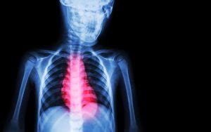 How to treat ischemic cardiomyopathy? Causes, symptoms, and prognosis