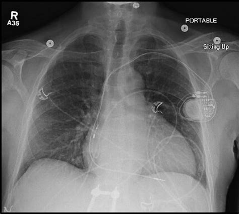 Chest x-ray demonstrating mild cardiomegaly with a dual-chamber... | Download Scientific Diagram