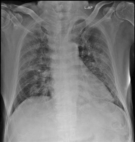 Chest X-ray showing bilateral pneumonia | Download Scientific Diagram