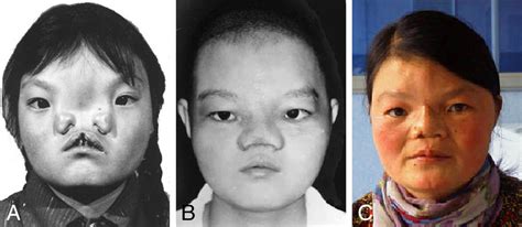 A patient of orbital hypertelorism with long-term outcomes, which was... | Download Scientific ...