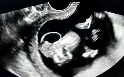 Iniencephaly Ultrasound