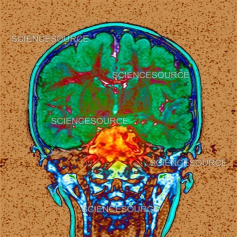 Brain cancer, MRI scan | Stock Image - Science Source Images