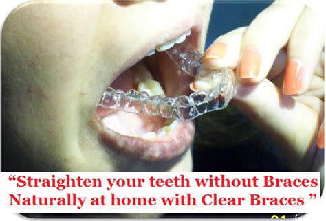 Invisible Braces for Adult | Dental Braces For Adults in IndiaFamous ...