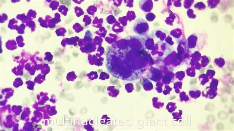 Osteoclastic And Pleomorphic Giant Cell Tumors Of The, 50% OFF