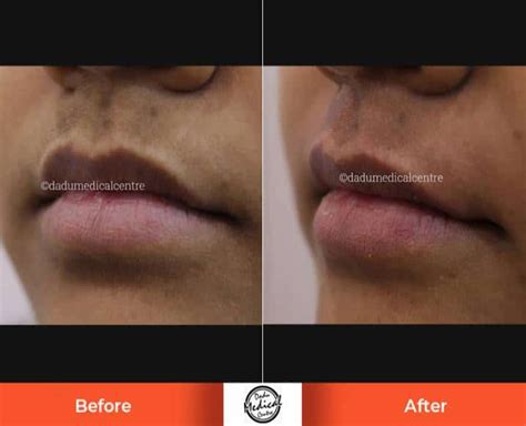 Real Results | Before and After Results of Upper Lip Hair Reduction