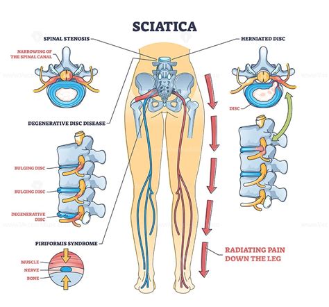 Sciatica pain or nerve weakness as leg lumbar radiculopathy outline diagram - VectorMine