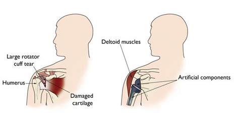 Reverse Shoulder Replacement - Krupa Orthopaedic Hospital