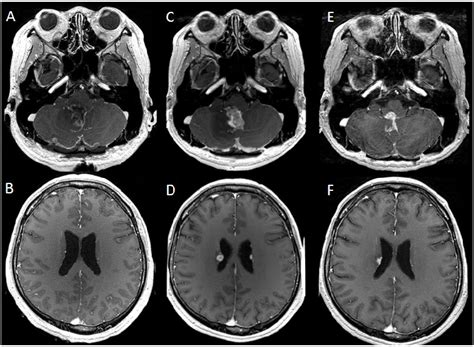 Postoperative magnetic resonance (MR) images: A, B. MR images enhanced... | Download Scientific ...