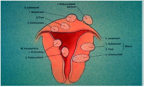 Uterine fibroids - Nashville Fertility