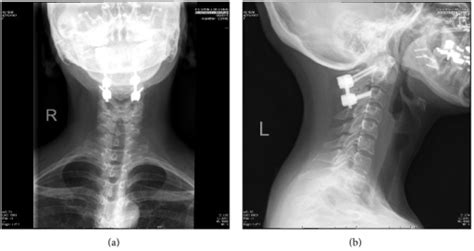 AP (a) and lateral (b) X-rays depicting a C1-2 fusion u | Open-i