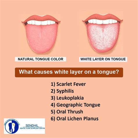 What Does Gonorrhea Look Like On The Tongue - What Does