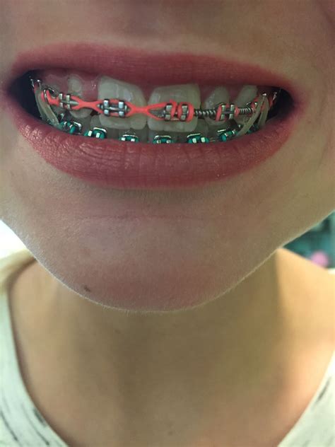 Pin by •Jaidyn Coots• on Braces | Braces colors, Cute braces, Dental braces