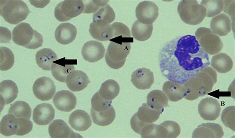 Classic image: peripheral blood smear in a case of Plasmodium falciparum cerebral malaria | BMJ ...