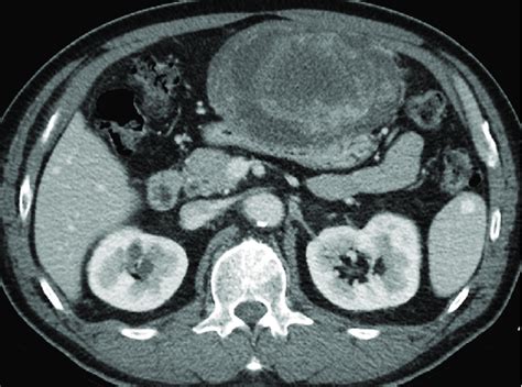 Extragastrointestinal gastrointestinal stromal tumor in a 62-yearold... | Download Scientific ...