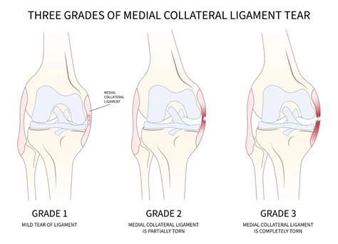 Medial Collateral Ligament (MCL) Injury