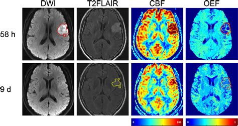 Ischemic Vs Hemorrhagic Stroke Mri