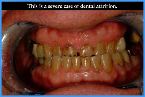 Attrition of Teeth - Larry Saylor D.M.D.