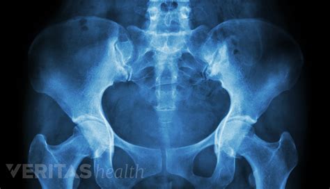 All About Sacroiliitis | Spine-health