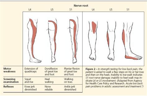 17 Best images about Back pain on Pinterest | Cauda equina syndrome, Back pain and The nerve