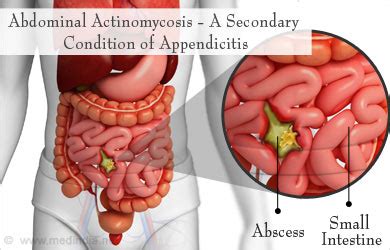 Actinomycosis | Lumpy Jaw - Symptoms, Diagnosis, Types, Treatment ...