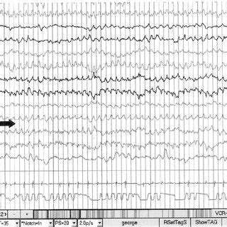 (PDF) The EEG in metabolic encephalopathy and coma