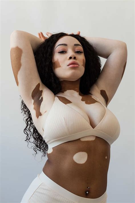 Pretty Different: The beauty of vitiligo – Savara Intimates