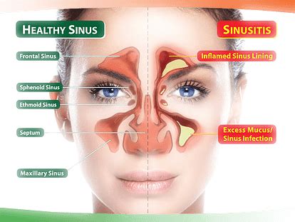 Sinusitis - Winchester, VA & Chantilly, VA: Allergy and Asthma ...