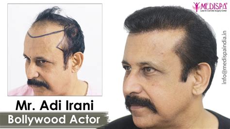 Bollywood Actor - Adi Irani Hair Transplant Results