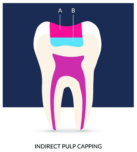 Graphical visualization of indirect pulp capping technique.... | Download Scientific Diagram