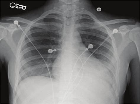 Basal Atelectasis X Ray