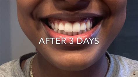 2 Impressive DIY Teeth Whitening Hacks: Baking Soda & Coconut Oil | Upstyle