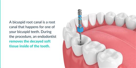 Root Canal Bicuspid - What Is a Bicuspid Tooth? | MENYC