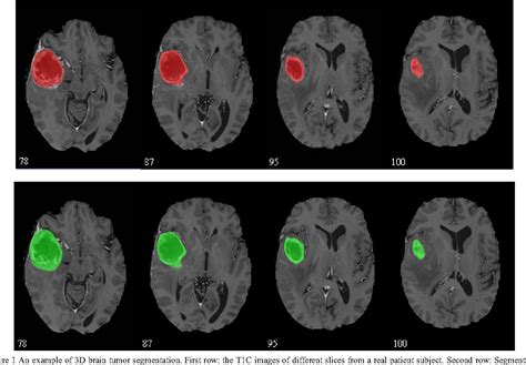 Figure 1 from Brain Tumor Segmentation in Multi-modality MRIs Using Multiple Classifier System ...