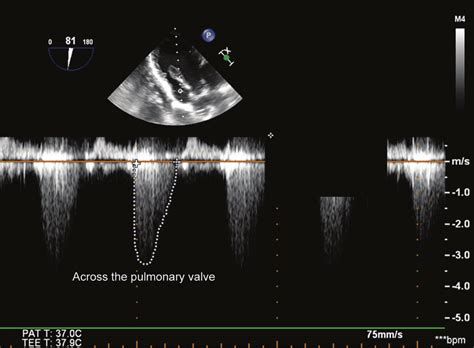 Gradient across the pulmonary valve. Note the characteristic early ...