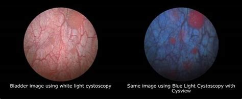 Blue Light Cystoscopy with Cysview - Brigham and Women's Faulkner Hospital