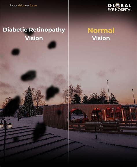 What are the types of diabetic retinopathy? - Global Eye Hospital