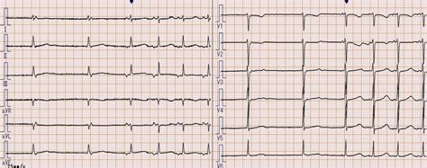 The electrocardiogram after surgery showing junctional rhythm with ...