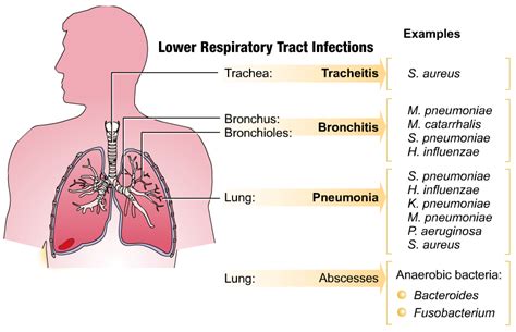 Respiratory Tract Infection Symptoms and Treatment